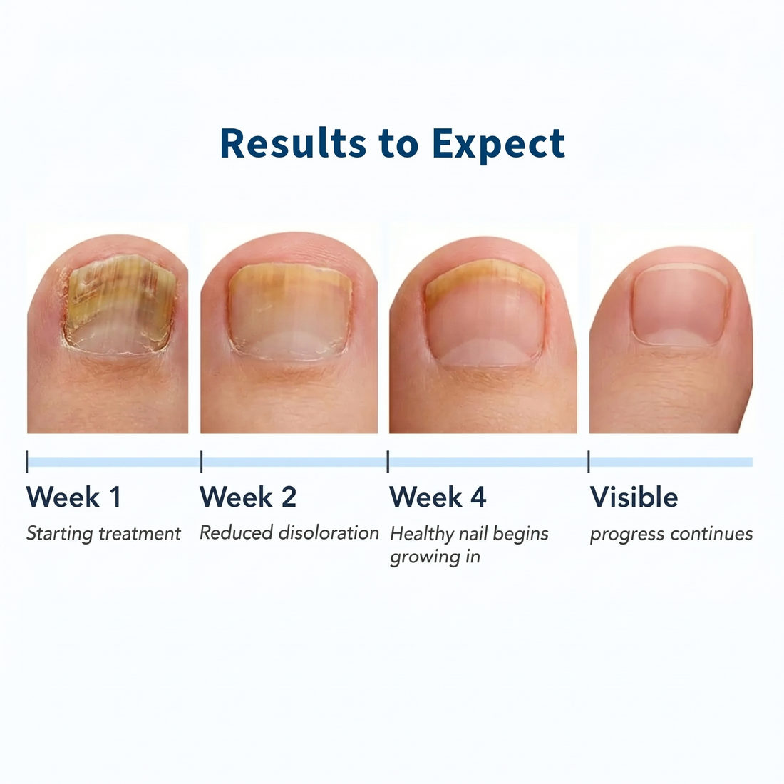 Serenbeau™ Fungal Nail Patches